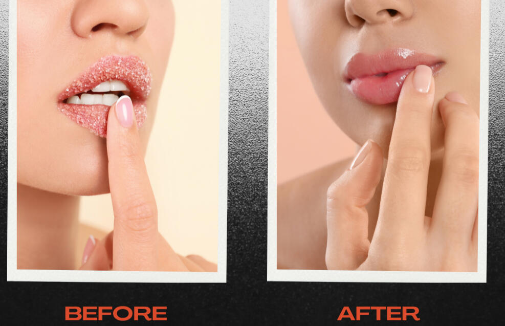 Blackheads removal